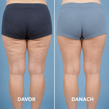 Lade das Bild in den Galerie-Viewer, Formkur - Anti-Cellulite- & Bindegewebs-Massagegerät